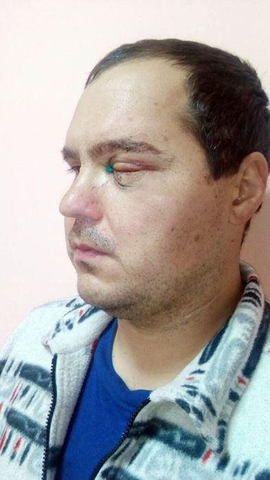 На Вінниччині п'яна жінка вдарила в око поліцейського: він осліп, суд відпустив підозрювану 