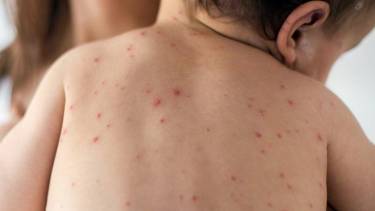 дитина захворіла на кір фото