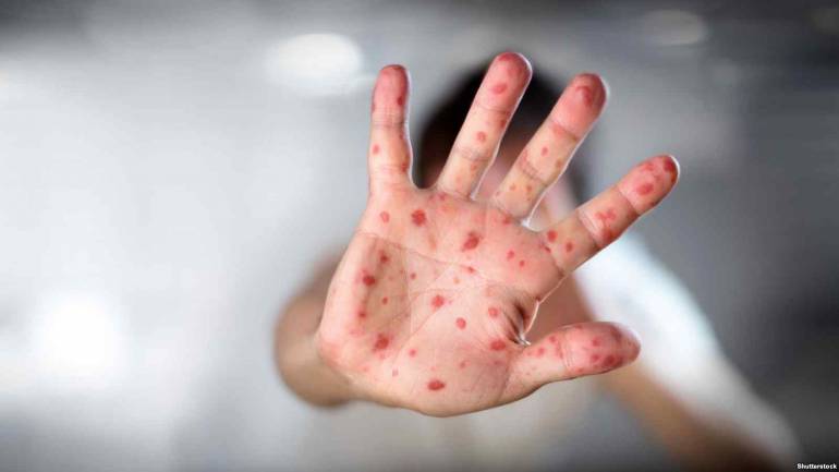 Більше півтисячі вінничан захворіли на кір за два тижні цього року