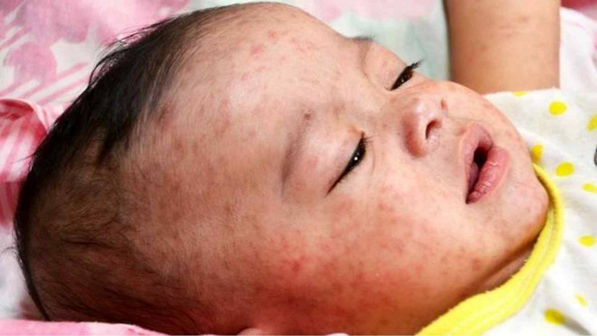 У Вінницькій області 3742 людини захворіли на кір